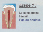 Carie étape 1 - Carie étape 1 -