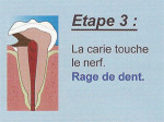 Carie étape 3 - Carie étape 3 -